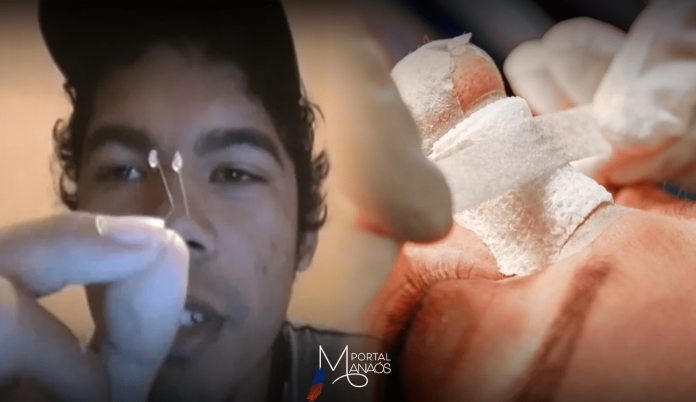 brasil-homem-e-internado-em-sp-apos-tentar-fazer-rinoplastia-caseira-seguindo-tutorial