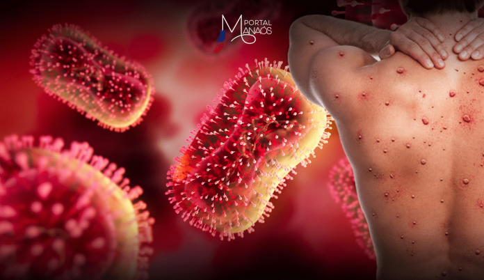 A Fundação de Vigilância em Saúde do estado (FVS-AM) divulgou, nesta quarta-feira (18), o novo boletim de registro dos casos de monkeypox ou MPOX, a varíola do macaco, em 2024. Com a nova atualização, já são 67 casos confirmados da doença no estado.