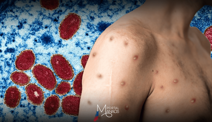 A Fundação de Vigilância em Saúde do estado (FVS-AM) divulgou, na última quarta-feira (4), o novo boletim de registro dos casos de monkeypox ou MPOX, a varíola do macaco, em 2024. Com a nova atualização, já são 61 casos confirmados da doença no estado.