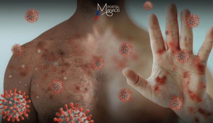 capa-varíola A Fundação de Vigilância em Saúde do Amazonas – Dra. Rosemary Costa Pinto (FVS-RCP), da Secretaria de Estado de Saúde (SES-AM), informou, na quarta-feira (08), o novo informe epidemiológico semanal da Mpox.