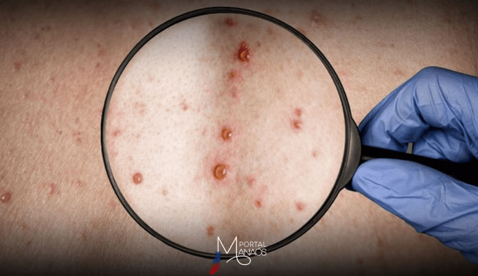 capa-variola-detecção