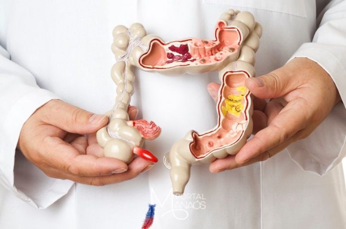 câncer colorretal Mortalidade por câncer colorretal na América Latina cresce 20,5% em trinta anos
