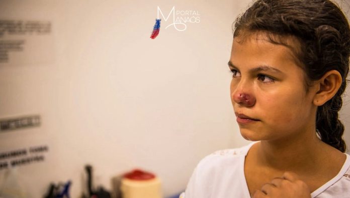 leishmaniose cutânea Institutos de pesquisa padronizam diagnóstico para leishmaniose cutânea nas Américas