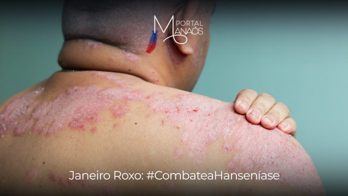'Janeiro Roxo' prevenção hanseníase 'Janeiro Roxo': Campanha de prevenção hanseníase