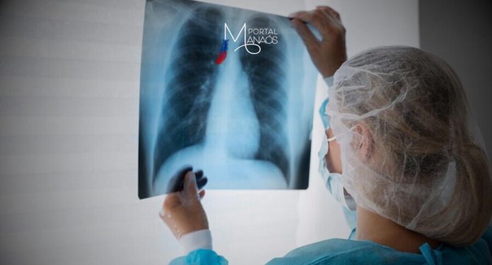 O Projeto de Lei 871/24 torna obrigatória a realização de exame espirométrico (espirometria) para pacientes inscritos ou em tratamento nos programas de cessação do tabagismo do Sistema Único de Saúde (SUS).