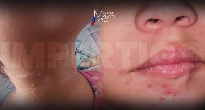 O Impetigo é uma infecção na pele causada por bactérias que habitam a pele, boca e trato respiratório superior que se manifesta mediante a queda no sistema imunológico, possibilitando a proliferação. Apesar da possibilidade de acometer pessoas de qualquer idade, o impetigo é mais comum em crianças entre dois e seis anos, especialmente nos meses mais quentes e úmidos do ano e em ambientes com condições de higiene precárias.