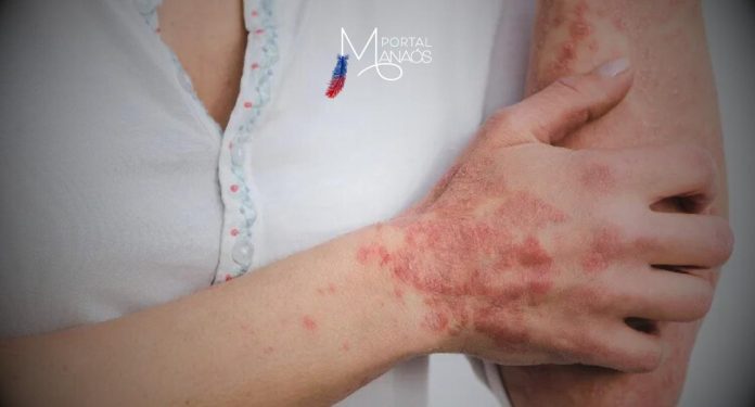 A Fundação de Vigilância em Saúde do Amazonas - Dra. Rosemary Costa Pinto (FVS-RCP), da Secretaria de Estado de Saúde (SES-AM), divulgou, na última terça-feira (26), o informe epidemiológico de esporotricose humana e animal, uma infecção subcutânea causada por fungos do gênero Sporothrix. O informe é dividido em dados de esporotricose humana e animal, notificados à FVS-RCP e é atualizado mensalmente, na última terça-feira do mês.